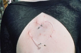 מיקרו דרמאל וספרפס פירסינג