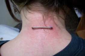 מיקרו דרמאל וספרפס פירסינג